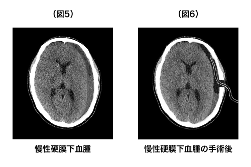 慢性硬膜下血腫の手術